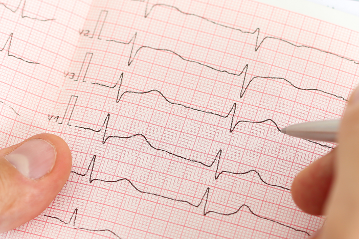 Ruhe EKG Erfassung der Herzstromkurve zur Abklärung von Herzrythmusstörungen und anderen Herzerkrankungen